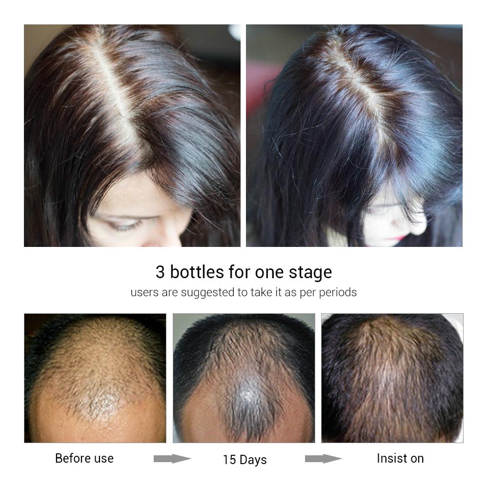 Изображение товара: Эссенция для роста волос LANBENA, спрей для предотвращения облысения, для укрепления волос, против выпадения волос
