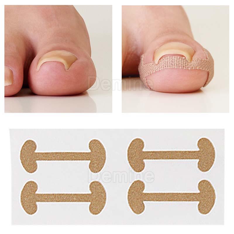 Изображение товара: Корректор для вросших ногтей на ногах, лечение паронихии, корректор для педикюра, инструменты для ухода за ногтями